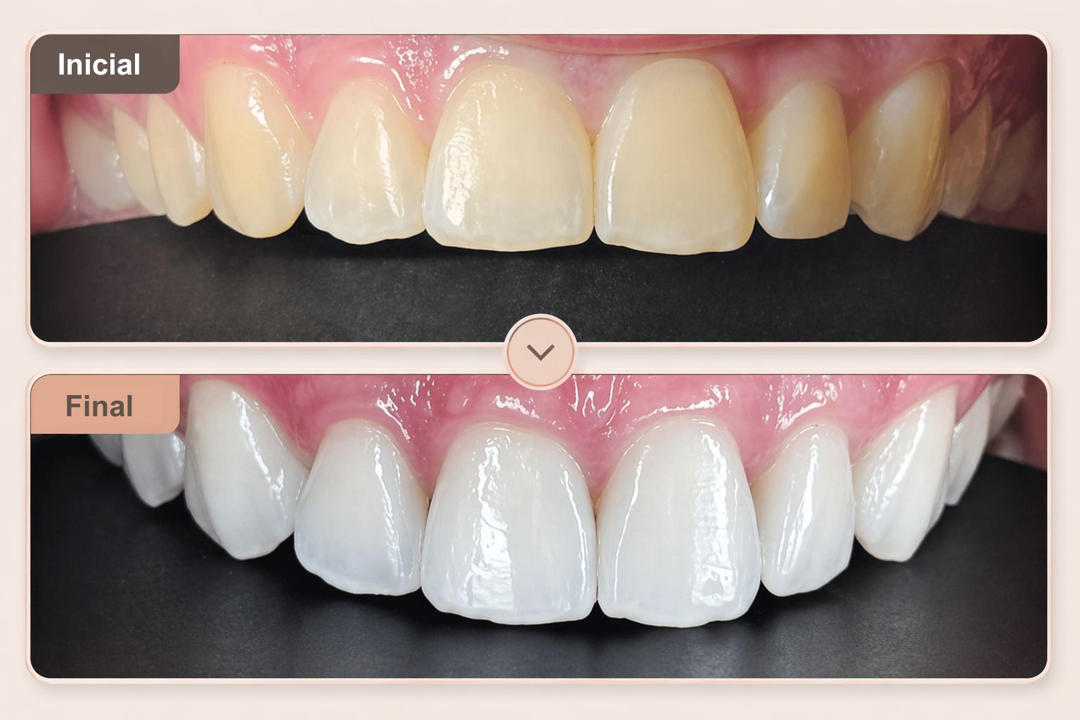 Antes e Depois Clareamento Dental