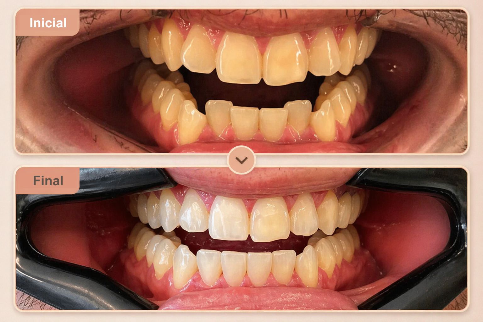 Antes e Depois Alinhadores SouSmile